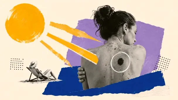 Cómo disfrutar del sol sin riesgo de desarrollar cáncer de piel