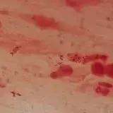 File:Gram Negative Rods and Pus cells in Gram staining.jpg