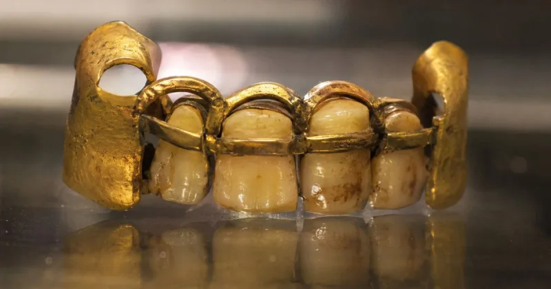 Prótesis dentales etruscas de hace 2.700 años son las más antiguas y sofisticadas conservadas de Europa