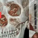 
			Acude a un médico y descubre que ha vivido con palillos en su cráneo durante 5 meses sin saberlo		