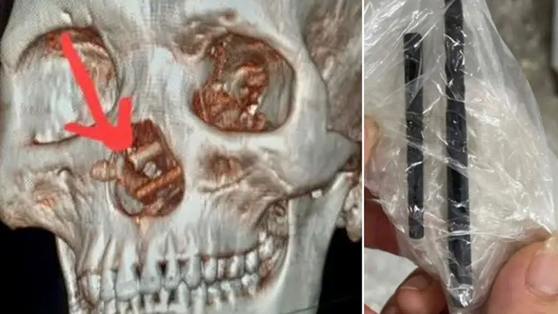 
			Acude a un médico y descubre que ha vivido con palillos en su cráneo durante 5 meses sin saberlo		
