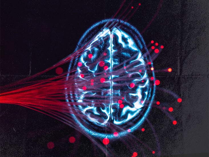 Schizophrenia: How blood vessel growth in the brain may be a factor
