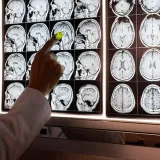 Could lowering brain cholesterol reduce Alzheimer’s-like damage?
