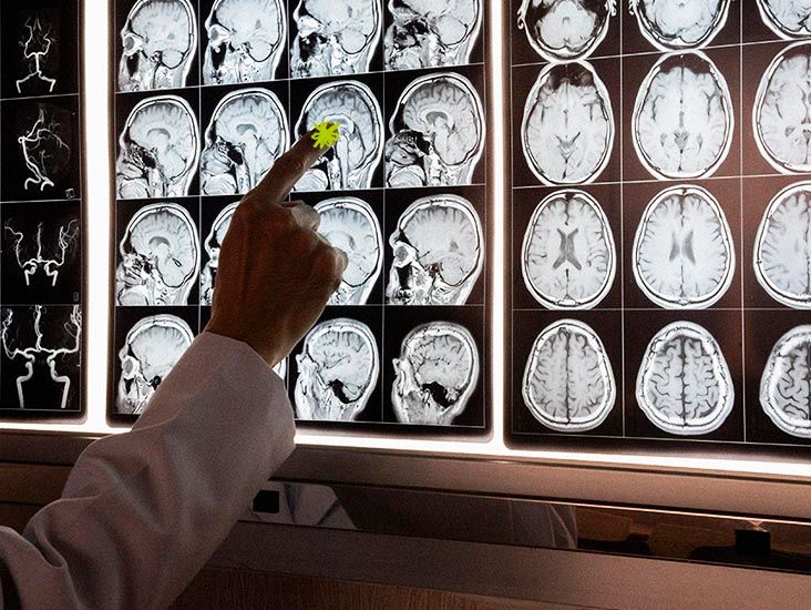 Could lowering brain cholesterol reduce Alzheimer’s-like damage?