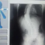 Niño con escoliosis necesita apoyo para su tratamiento médico