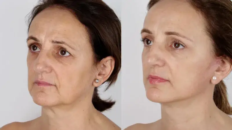 Los efectos de la rápida pérdida de peso en el rostro