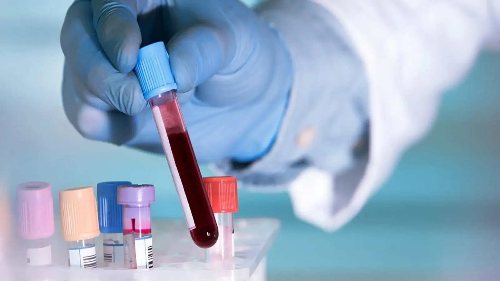 Prueba de sangre detecta a tiempo el regreso del cáncer de mama