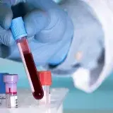 Prueba de sangre detecta a tiempo el regreso del cáncer de mama
