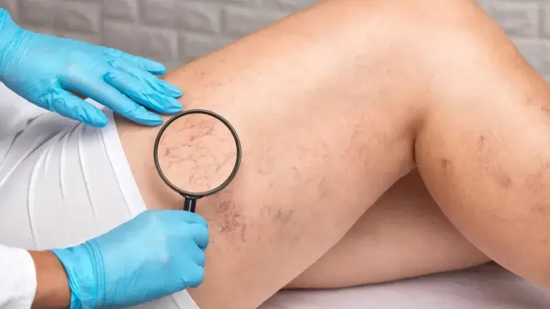 Nuevas técnicas ambulatorias permiten tratar las varices sin anestesia