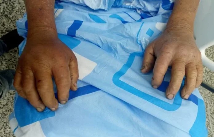 Miranda: Una mapanare mordió dos veces a un septuagenario