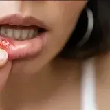 Causas y alivio de las úlceras bucales
