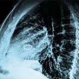 How minimally invasive TAVR surgery could benefit people with aortic stenosis