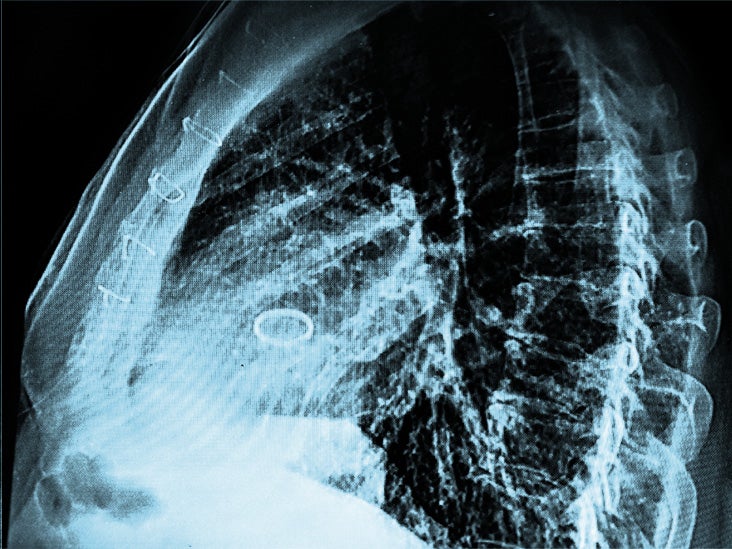 How minimally invasive TAVR surgery could benefit people with aortic stenosis