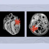 Catheter treatment for atrial fibrillation may reduce dementia risk