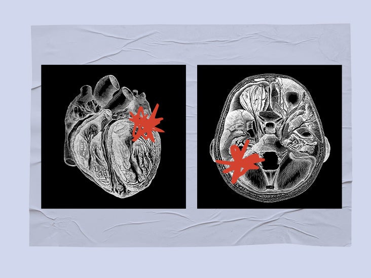 Catheter treatment for atrial fibrillation may reduce dementia risk