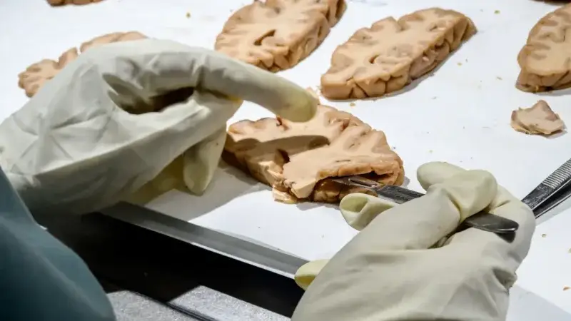 Un examen de sangre podría anticipar el Alzheimer 10 años