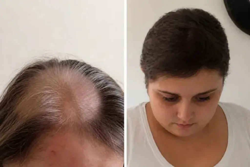 Doce años de quimioterapia por un tumor cerebral que no tenía