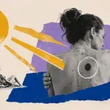 El melanoma ya suma 5.000 diagnósticos al año en España