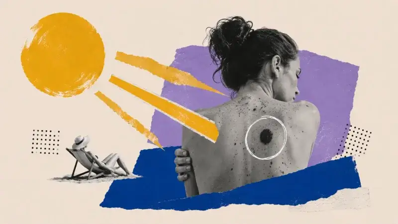 El melanoma ya suma 5.000 diagnósticos al año en España