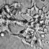 Vacuna de Moderna y Merck contra el melanoma supera la fase 3