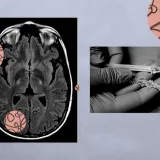 ALS treatment: FDA to rule on drug tofersen for specific type of the disease