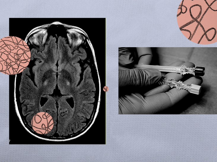 ALS treatment: FDA to rule on drug tofersen for specific type of the disease